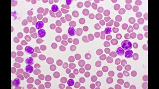 Understanding Chronic Lymphocytic Leukemia (CLL): An Introduction